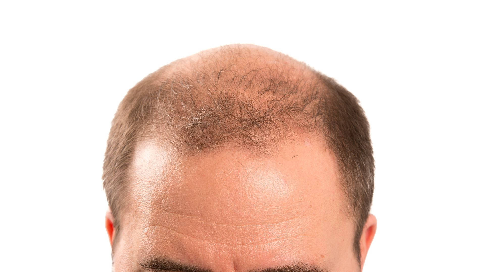 Bald Man With Fading Thin Hair Wallpaper